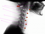 めまい、ストレートネックの方のX-Ray